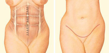 Tummy tuck incision front abdomen sutures