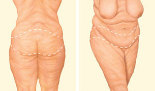 Lower body lift incision