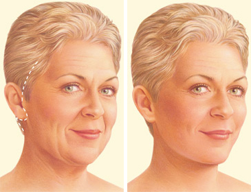 facelift traditional incision