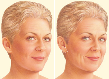 Facelift limited incision