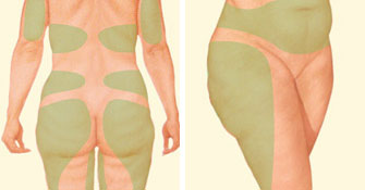 Liposuction problem areas